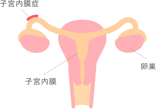 子宮内膜症について