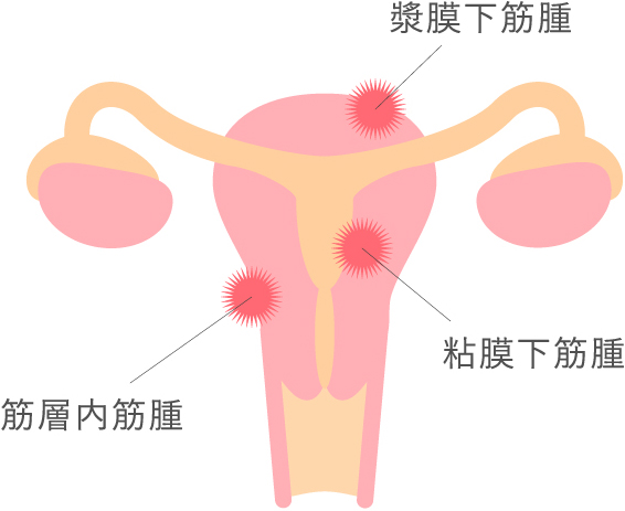 子宮筋腫について