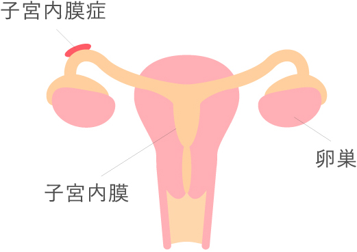 子宮内膜症について