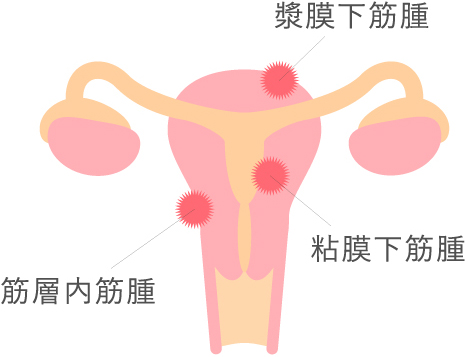 子宮筋腫について