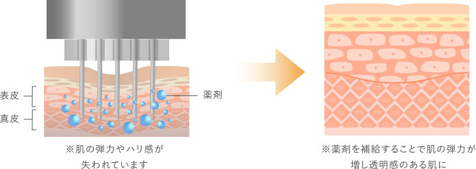 水光注射とは