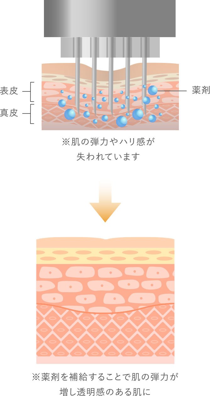 水光注射とは
