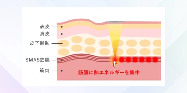 たるんだ肌がリフトアップする仕組み