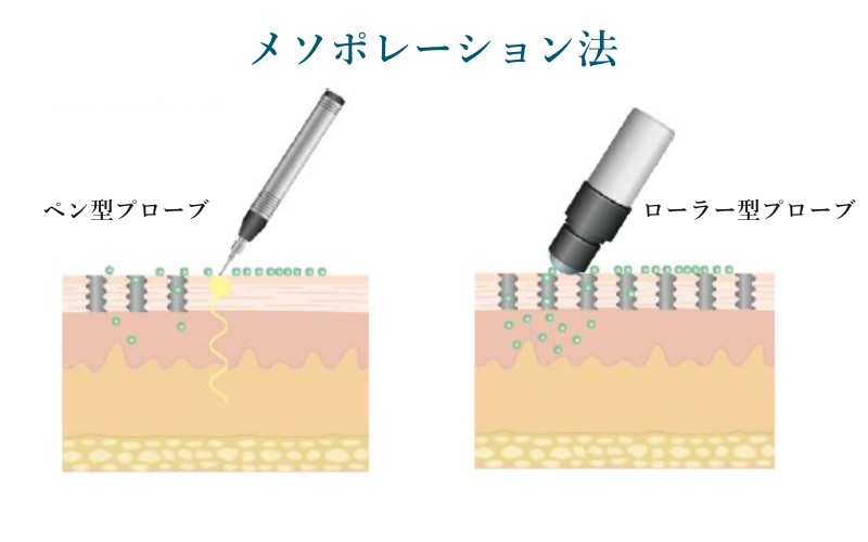 イオン導入の約70倍の浸透率