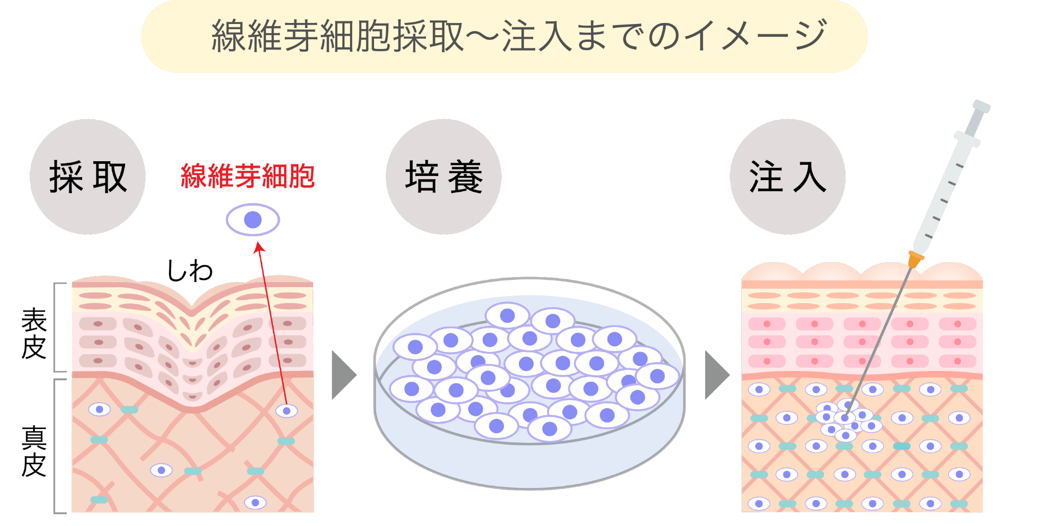 線維芽細胞採取〜注入までのイメージ
