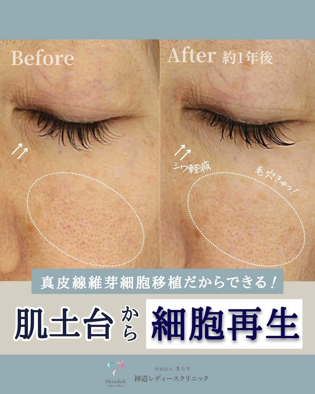 真皮線維芽細胞 症例1