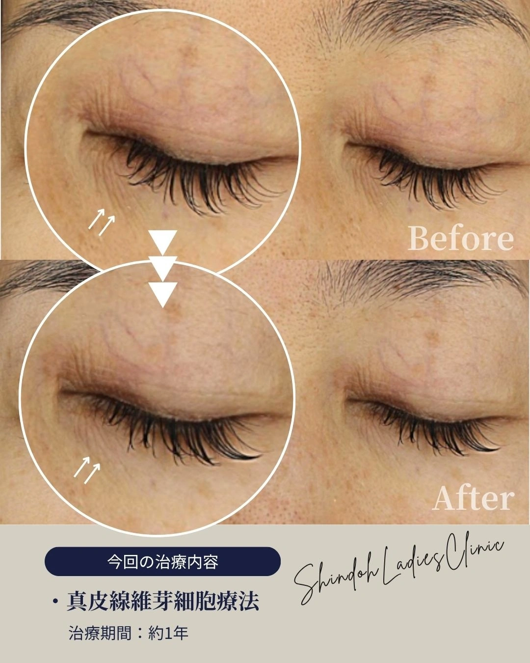 真皮線維芽細胞 症例1