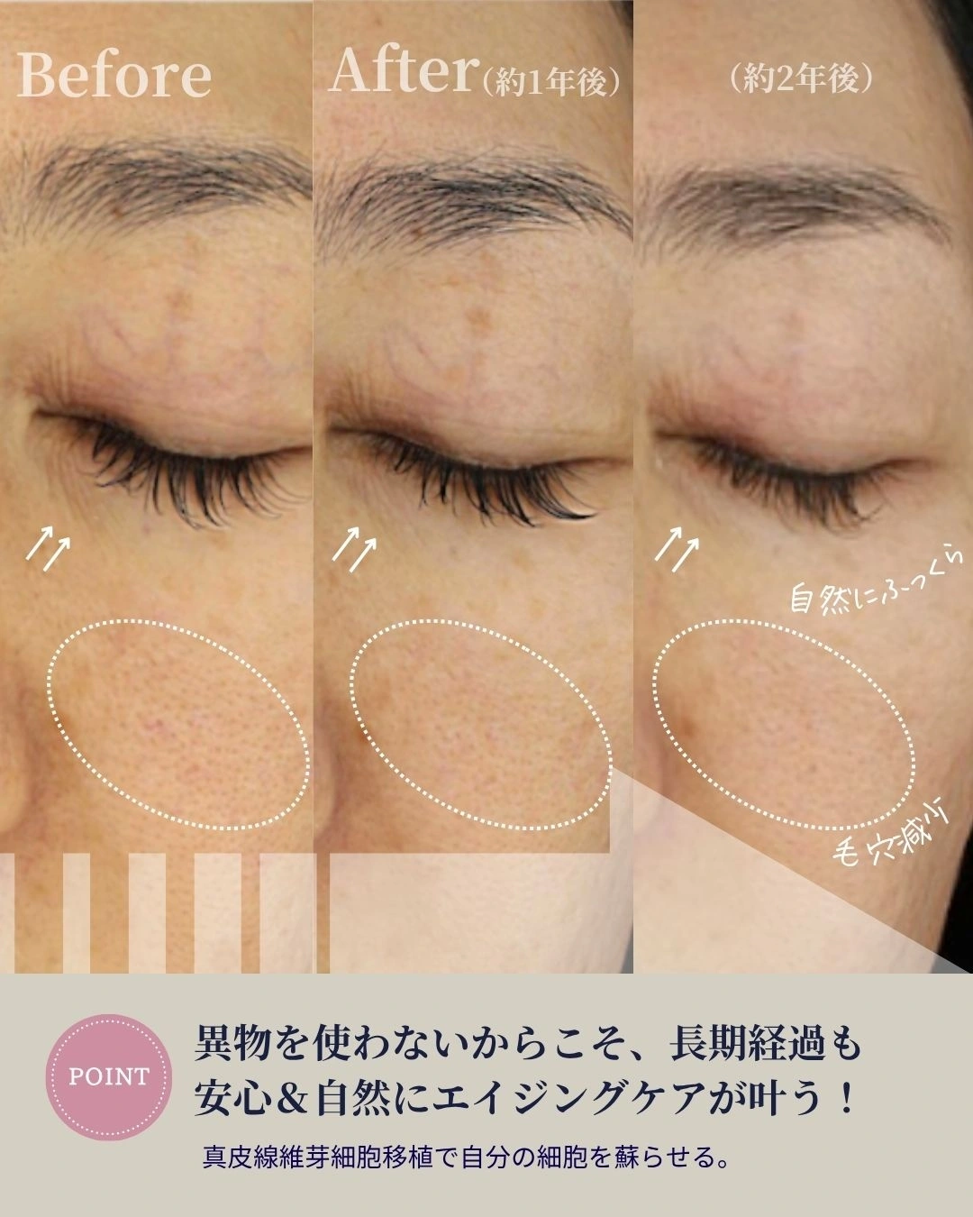 真皮線維芽細胞 症例1