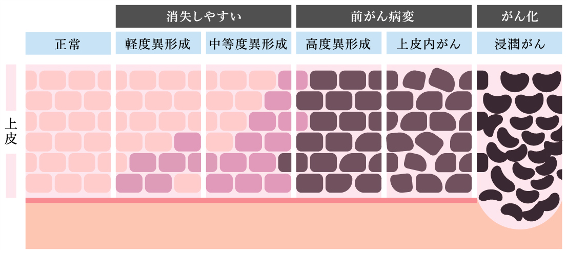 子宮頸がんの進行