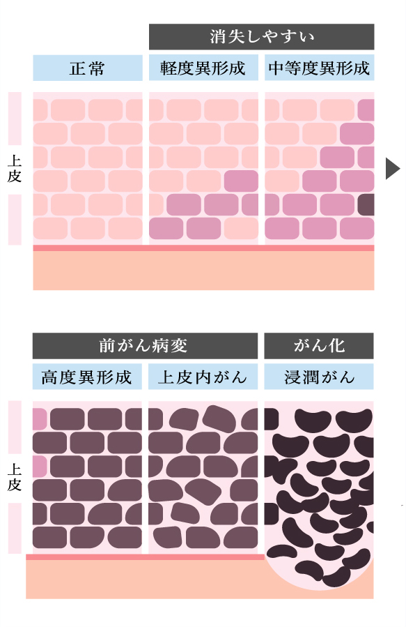 子宮頸がんの進行