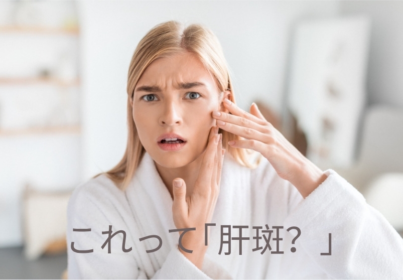 【キャンペーンあり】肝斑にお悩みの方必見！～効果的な改善方法～