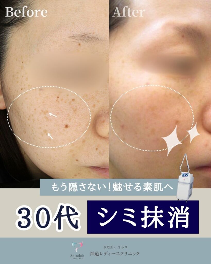 もう隠さない！魅せる素肌へ 30代シミ抹消