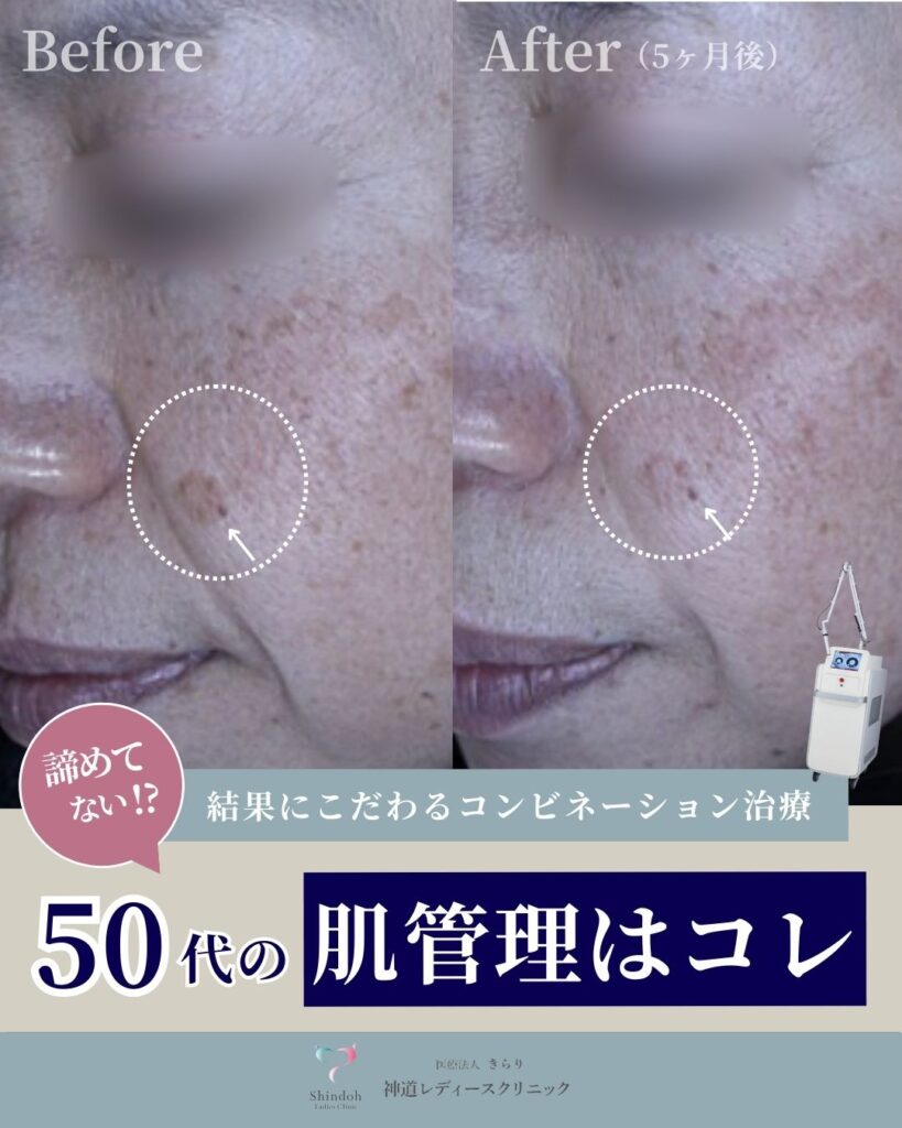 📍結果にこだわるコンビネーション治療✨50代の肌管理💎