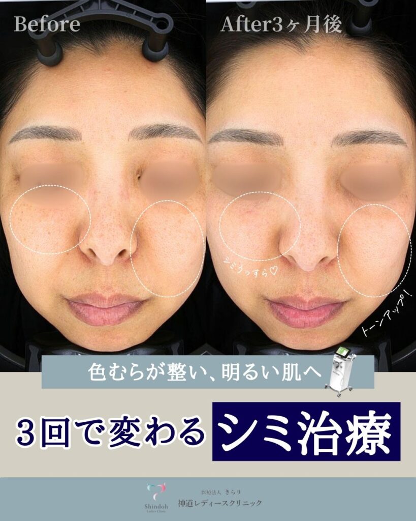 【大阪・門真・守口市】3回で変化するシミ治療｜ルメッカ（IPL）の症例をご紹介