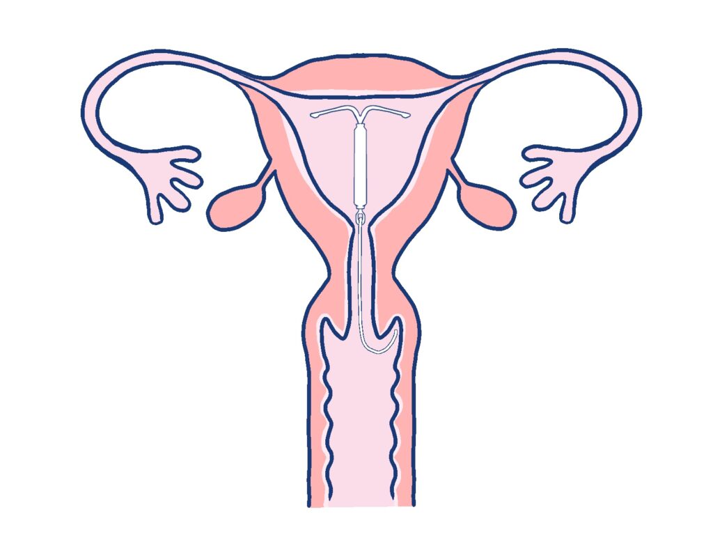 【大阪府門真市の産婦人科】ミレーナとは？避妊だけでなく生理痛・過多月経の治療にも｜神道レディースクリニック