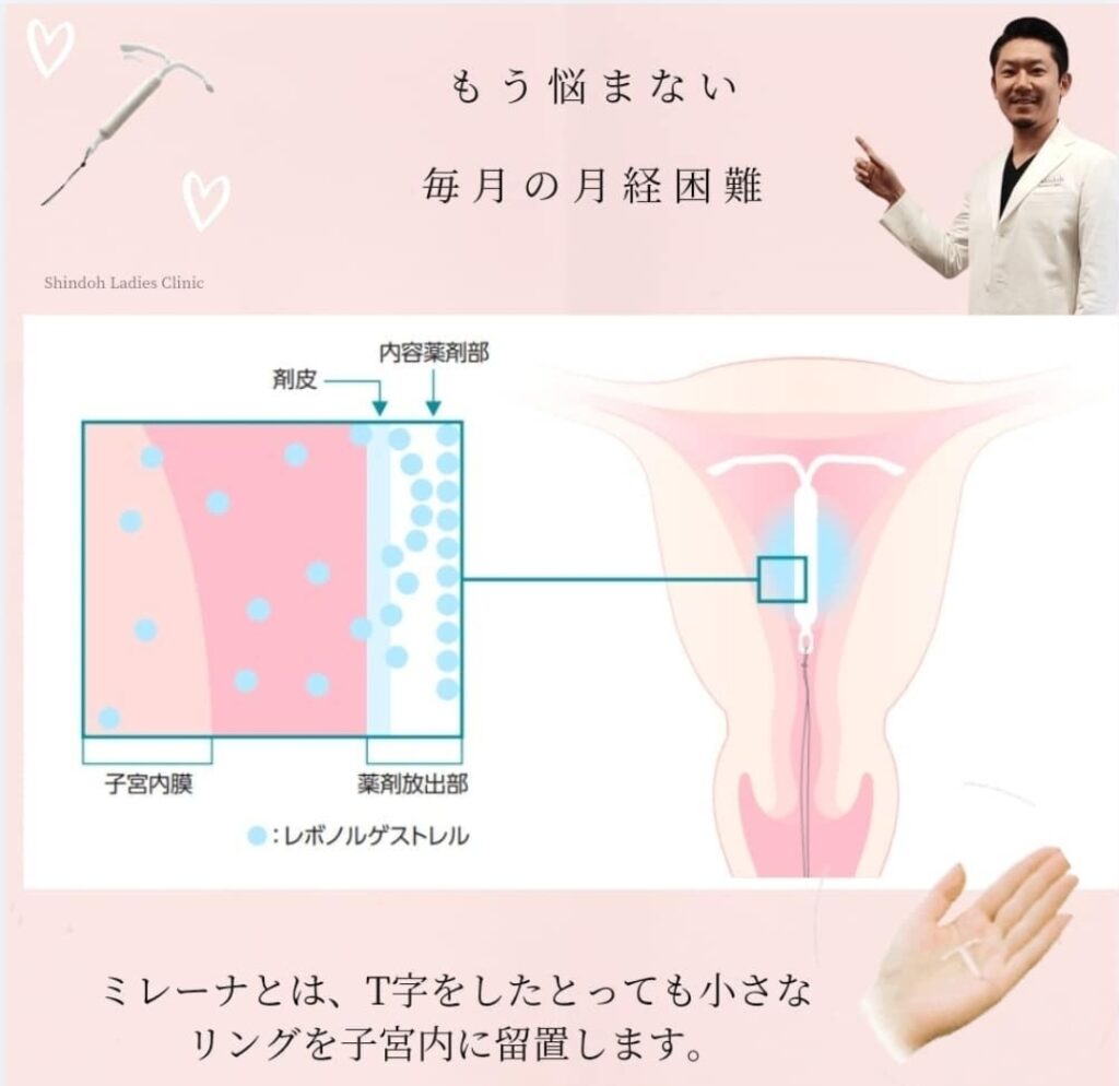 ミレーナってなぁに??
